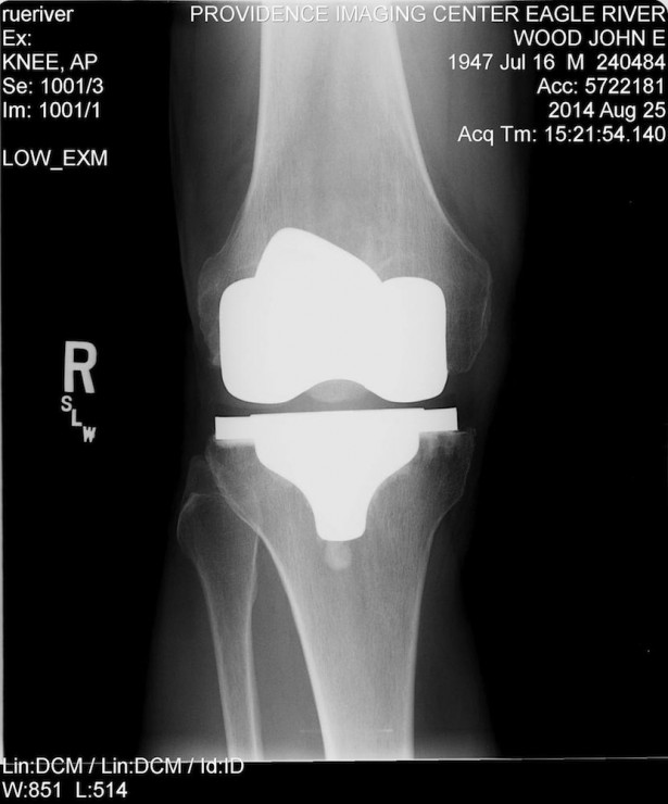Right knee at one-year checkup (Photo: John Wood)