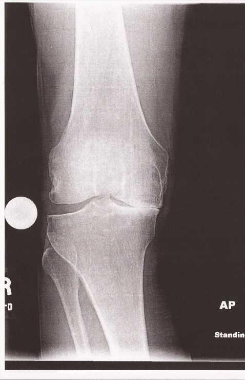 Right knee prior to surgery.  Note the bone-to-bone contact and lower leg angle. (Photo: John Wood)